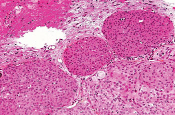 Image: A histopathology of a meningioma with brain invasion (WHO Grade II); the tumor (bottom/right of image) has the typical \"pushing border\" invasion into the cerebral cortex (Photo courtesy of Nephron).