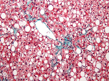 Image: A micrograph of non-alcoholic fatty liver disease (NAFLD). The liver has a prominent macrovesicular steatosis (white/clear round/oval spaces) and mild fibrosis (green). The hepatocytes stain red. Macrovesicular steatosis is lipid accumulation that is so large it distorts the cell\'s nucleus (Photo courtesy of Wikimedia Commons).