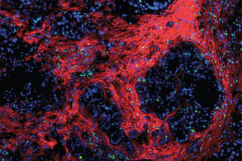 Image: Pancreatic tumors are surrounded by a protective \"nest\" made of fibrotic scar tissue and the cells that manufacture it (red). A new study in mice demonstrates that disrupting this fibrous tissue makes immune therapy and chemotherapy more effective in attacking tumors of the pancreas (Photo courtesy of the DeNardo Laboratory, Washington University School of Medicine).