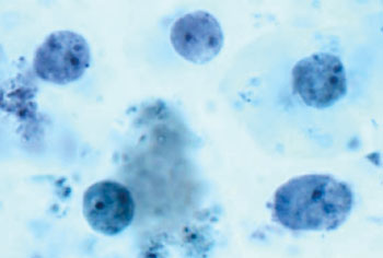 Image: The protozoan parasite Dientamoeba fragilis from a stool sample. Trophozoites exhibit an amoeba-like morphology and are often bi-nucleated (Photo courtesy of Tulane University).