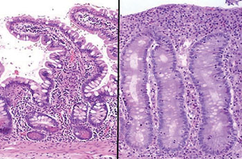 Image: A histology of the small intestinal mucosa; the normal is on the left. The mucosa involved by celiac disease (sprue) at the right has blunting and flattening of villi (Photo courtesy of the CDC).