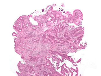 Image: An invasive adenocarcinoma (the most common type of colorectal cancer). The cancerous cells are seen in the center and at the bottom right of the image (blue). Near normal colon-lining cells are seen at the top right of the image (Photo courtesy of Wikimedia Commons).