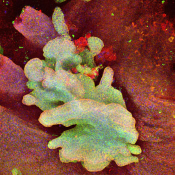 Image: The green-labeled cells show a basal cell carcinoma in mouse tail epidermis derived from a single mutant stem cell and expanding out of the normal epidermis stained in red (Photo courtesy of Adriana Sánchez-Danés, Université Libre de Bruxelles).