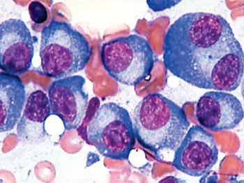 Image: Bone marrow aspirate of a patient with multiple myeloma showing large immature-appearing plasma cells with prominent nucleoli and finer nuclear chromatin (Photo courtesy of Pennsylvania State University).