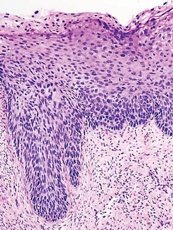 Image: A histopathology of high-grade cervical intraepithelial neoplasia CIN 3. There is severe dysplasia that involves more than 2/3 of the epithelium, and may involve the full thickness. This lesion may sometimes also be referred to as cervical carcinoma in situ (Photo courtesy of Dr. Sean Kavanagh).
