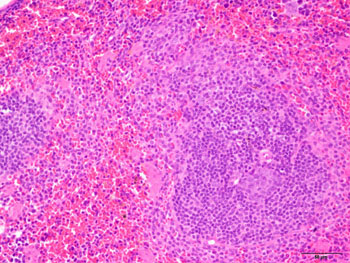 Image: In the mouse spleen, lymphoid tissue (purple) is responsible for launching an immune response to blood-born antigens, while red pulp (pink) filters the blood. Mutations in the C9ORF72 gene, the most common mutation found in ALS patients, can inflame lymphoid tissue and contribute to immune system dysfunction (Photo courtesy of Dr. Dan Mordes, Eggan Laboratory, Harvard Stem Cell Institute).