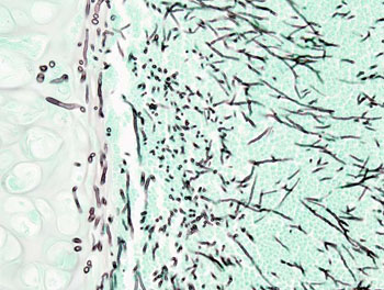 Image: A histopathology image of pulmonary invasive aspergillosis in a patient with interstitial pneumonia (Grocott\'s methenamine silver stain) (Photo courtesy of Wikimedia).