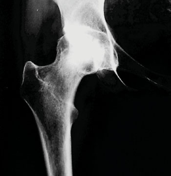 Image: A radiograph of osteonecrosis of the right hip. Note the alternating areas of sclerosis and lucency in the femoral head. There are areas of collapse within the head as well as mild degenerative changes on the acetabular side (Photo courtesy of Dr. Brett Levine, MS, MD, and Dr. William Jaffe, MD).