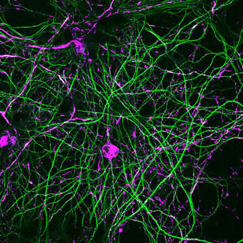Image: Primary hippocampal neurons from mice expressing G2019S-LRRK2. The neurons were treated with alpha-synuclein fibrils, and 18 days later immunofluorescence was performed. The magenta shows phospho-alpha-synuclein inclusions in the cell bodies and throughout the axons, which are visualized as green (Photo courtesy of the University of Alabama).