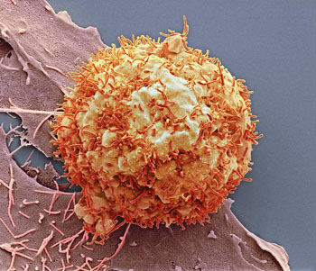 Image: A scanning electron micrograph (SEM) of a liver cancer cell (Photo courtesy of SPL).