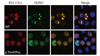 Image: Microscope images showing the Thr47Pro mutation in the BCL11A gene changes the distribution of BCL11A protein in a cell, which also prevents it from co-localizing with NONO, another protein implicated in intellectual development (Photo courtesy of the American Journal of Human Genetics).