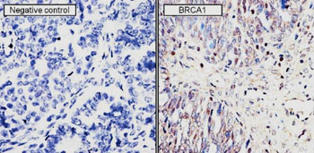 Image: An immunohistochemistry analysis of BRCA1 performed on normal tissue and human ovary carcinoma tissue (Photo courtesy of the CDC).