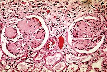 Image: A histopathology of nodular glomerulosclerosis in the kidney of a patient with diabetic nephropathy (Photo courtesy of the CDC).