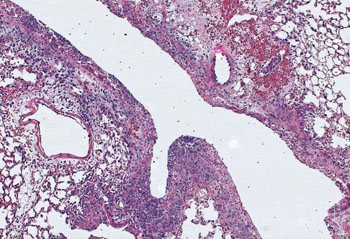 Image: A photomicrograph of lung tissue infected by pneumonia bacteria (Photo courtesy of Alexandra Bettina, University of Virginia).