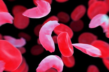 Image: Healthy blood cells along with sickle-cell diseased cells (Photo courtesy of Science Picture Co./Corbis).