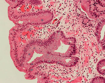 Image: A histopathology showing simple columnar metaplasia of the epithelium of Barrett\'s Esophagus characterized by goblet cell (Photo courtesy of Nephron).