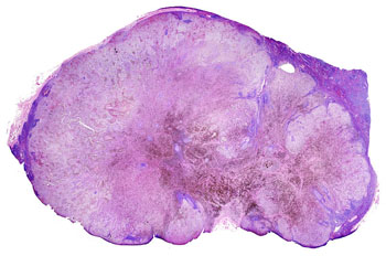 Image: A lymph node with almost complete replacement by metastatic melanoma (Photo courtesy of Wikimedia Commons).