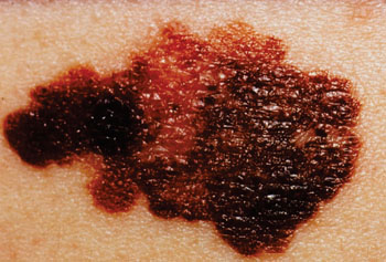 Image: A malignant melanoma on a patient’s skin (Photo courtesy of the National Cancer Institute).