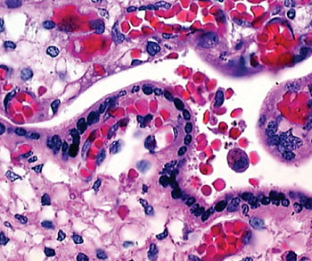 Image: A histopathology of a malaria-infected placenta (Photo courtesy of Dr. Michal Fried).