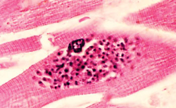 Image: A histopathology of active toxoplasmosis of the myocardium. Numerous tachyzoites of Toxoplasma gondii are visible within a pseudocyst in a myocyte (Photo courtesy of Dr. Edwin P. Ewing, Jr.).