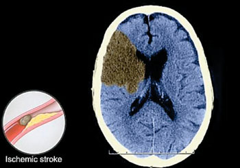 Image: Ischemic stroke: The culprit is a blood clot that obstructs a blood vessel inside the brain. The clot may develop on the spot or travel through the blood from elsewhere in the body (Photo courtesy of Dr. James Beckerman, MD, FACC).
