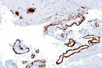 Image: Micrograph showing immunostained amyloid beta (brown) in senile plaques of the cerebral cortex (upper left of image) and cerebral blood vessels (right of image) (Photo courtesy of Wikimedia Commons).