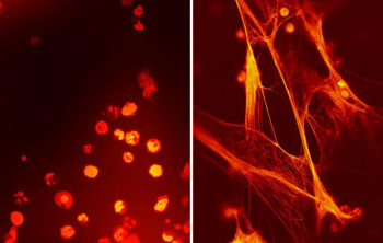 Image: Infection fighting cells from umbilical cord blood (left) and circulating blood three days after birth (right) from the same prematurely born baby. Umbilical cord blood has high levels of neonatal NET inhibitory factor (nNIF), which inhibits formation of neutrophil extracellular traps (NETs) (Photo courtesy of Mark Cody/Diana Lim, University of Utah Health Care).
