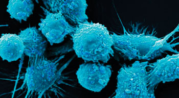 Image: A colorized scanning electron micrograph (SEM) of human prostate cancer cells (Photo courtesy of Dr. Gopal Murti).
