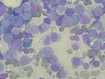 Image: A photomicrograph of bone marrow aspirate showing acute myeloid leukemia (AML) (Photo courtesy of Wikimedia Commons).