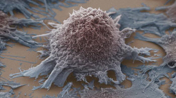 Image: Lung cancer cells (Photo courtesy of SPL).