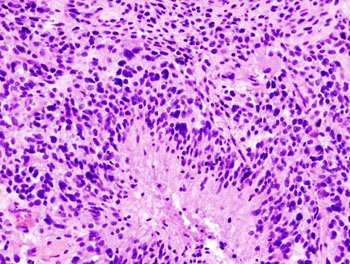 Image: A histopathological image of cerebral glioblastoma with Hematoxylin and esoin stain (Photo courtesy of Wikimedia Commons).
