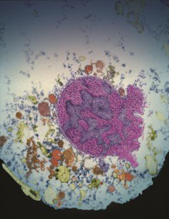 Image: The nucleus of a cell undergoing parthanatos (Photo courtesy of Yingfei Wang and I-Hsun Wu, Johns Hopkins University).