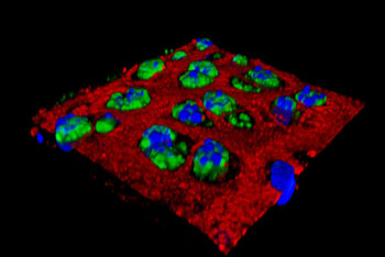 Image: Researchers have found that injecting nanoparticles into an injured joint can inhibit the inflammation that contributes to the cartilage damage seen in osteoarthritis. Shown in green is an inflammatory protein in cartilage cells. After nanoparticles are injected, the inflammation is greatly reduced (Photo courtesy of the Pham Laboratory, Washington University School of Medicine).