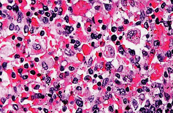 Image: A photomicrograph of a bone marrow showing stromal macrophages containing numerous red blood cells in their cytoplasm from a patient with hemophagocytic lymphohistiocytosis (Photo courtesy of Nephron).