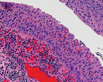 Image: A histopathology of acute cystitis of the bladder (Photo courtesy of the University of Maryland School of Medicine).