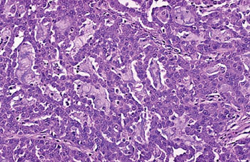 Image: A histopathology of a moderately differentiated adenocarcinoma of colon showing a glandular configuration, but the glands are irregular and very crowded. Many of them have lumens containing bluish mucin (Photo courtesy of Raul Gonzalez MD).