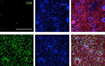 Image: In this image, the top row shows few T-cells in untreated mice, while the bottom rows show many T-cells produced after immunotherapy treatment (Photo courtesy of Massachusetts Institute of Technology).