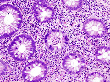 Image: A histopathology image of the active stage of ulcerative colitis (Photo courtesy of Wikimedia).