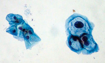 Image: A thin preparation pap smear with group of normal cervical cells on left and HPV-infected cells showing features typical of koilocytes: enlarged nuclei and hyperchromasia (Photo courtesy of Ed Uthman, MD).
