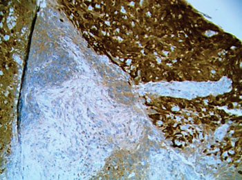 Image: Immunohistochemistry image of invasive squamous cell carcinomas of tonsil tissue showing overexpression of p16, which is a very good surrogate marker for HPV infection (Photo courtesy of David C. Hoak, MD).