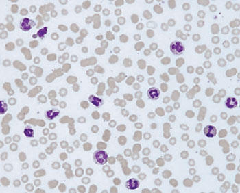 Image: A blood film from a patient with bladder cancer showing increased number of neutrophils and band cells (Photo courtesy of MPH).