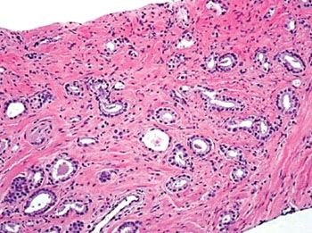 Image: A histopathology of prostate cancer showing multiple poorly formed glands with ill-defined lumina and/or incomplete nuclear complement (Photo courtesy of European Urology).
