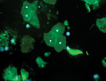 Image: Placental fetal cells isolated safely using the TRIC procedure were stained for beta- human chorionic gonadotropin (hCG) (green) a trophoblast cell marker and nuclei were labeled using DAPI dye (Photo courtesy of Sascha Drewlo, PhD).