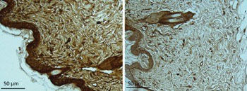 Image: Huntingtin aggregates (brown) are elevated in skin sections from HD model mice (left). Levels are reduced after treatment with P110 (right) (Photo courtesy of Disatnik).