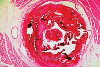 Image: A histopathology of a venous thrombus in a leg muscle (Photo courtesy of Nigel Lang).