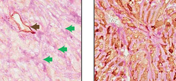 Image: Two adjacent sections of a mouse breast tumor. Tissue at left is stained so that normal blood vessels can be seen (black arrow). Extending from these vessels are blood filled channels (green arrows). On the right, the tissue is stained for a fluorescent protein expressed by the tumor cells. Here it is seen that blood-filled channels are actually formed by tumor cells in a process known as vascular mimicry (Photo courtesy of Cold Spring Harbor Laboratory).