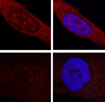 Image: Photomicrographs of fibroblasts from patients with Huntington\'s disease marked with fluorescence. Top row: the cells have accumulated mutant RNA. Bottom row: the cells no longer show blocked RNA accumulations (Photo courtesy of the Center for Genomic Regulation).