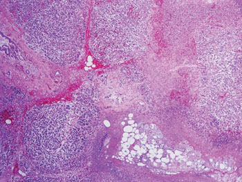 Image: A histopathology of acute pancreatitis showing hemorrhage, parenchymal necrosis, and fat necrosis (Photo courtesy of Kathryn Lindsey, MD).