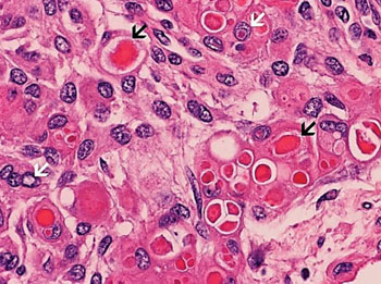Image: A histopathology of rhabdoid meningiomas characterized by enlarged epithelioid cells with large nuclei and prominent nucleoli. Bright intracellular secretions (black arrows) are present. Note that the sizes of these vacuoles are several times the size of the nuclei. Intranuclear pseudoinclusions are also present (white arrows) (Photo courtesy of Kar-Ming Fung, MD, PhD).