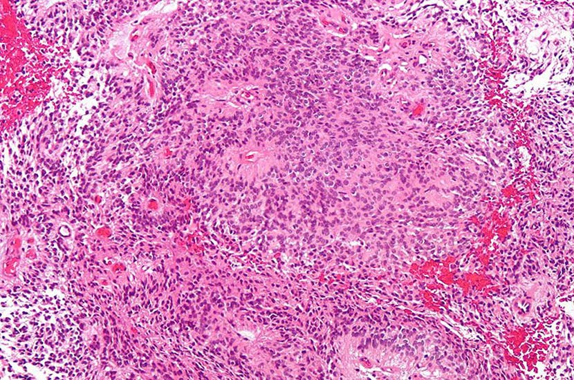 Image: A micrograph of an ependymoma (Photo courtesy of Wikimedia Commons).